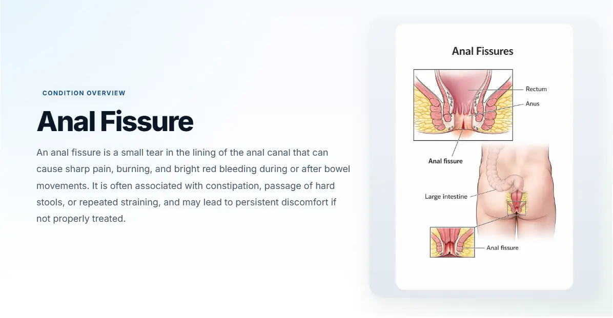 Anal Fissure | Symptoms, Causes & Treatment