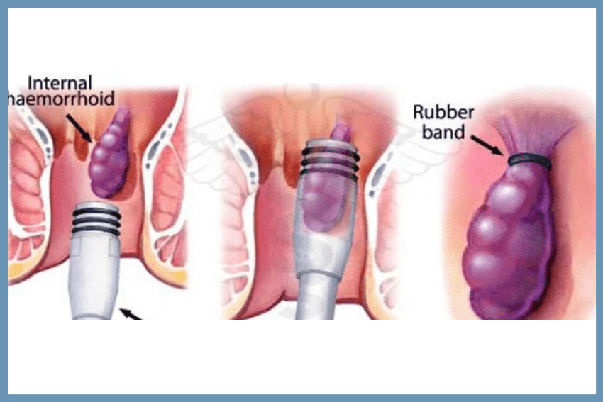 Rubber band ligation procedure for internal hemorrhoids