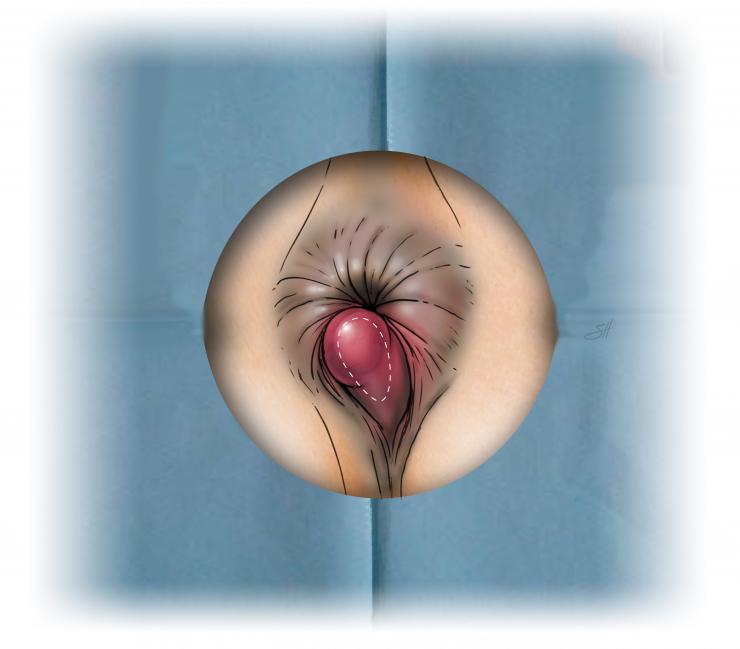 Thrombosed hemorrhoid with blood clot