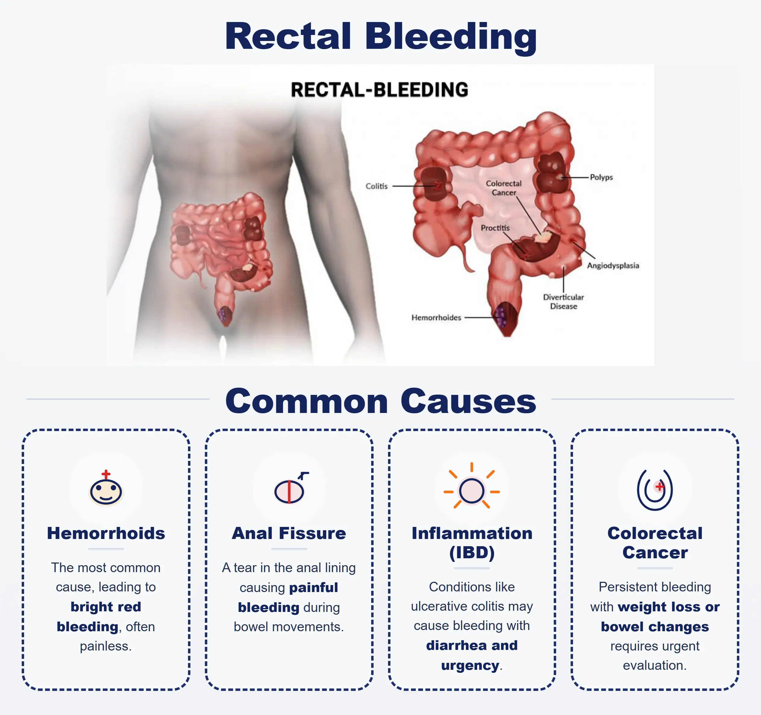 Medical illustration showing bright red blood dark stool abdominal pain and associated symptoms of rectal bleeding