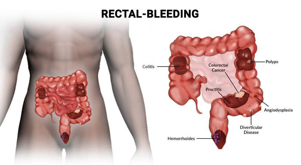 Medical diagram showing causes of rectal bleeding including hemorrhoids anal fissures polyps and colon conditions