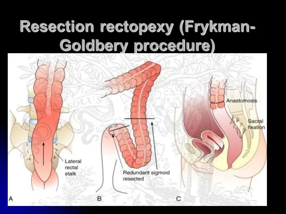 Medical illustration showing rectopexy as a surgical treatment for rectal prolapse