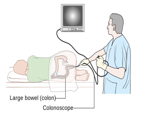 Preparación para colonoscopía - AGA GI Patient Center